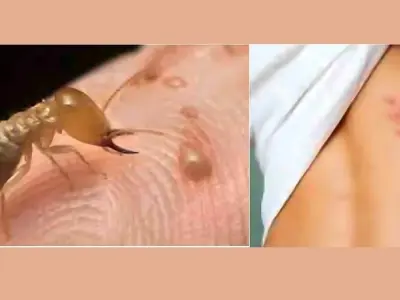 Bị mối cắn có sao không và cách xử lý đúng cách