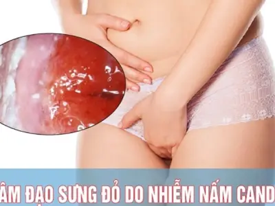 Bị nấm candida có sao không và cách điều trị hiệu quả