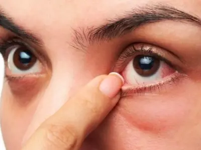 Bị ngứa mắt có sao không và cách xử lý hiệu quả