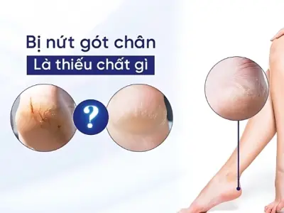 Bị nứt gót chân là thiếu chất gì và dấu hiệu đi kèm