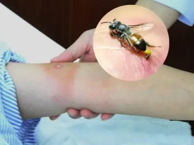 Bị ong đốt có sao không? Cách xử lý nhanh và hiệu quả