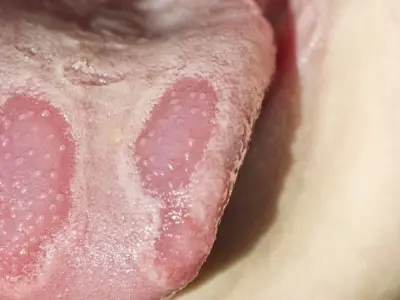 Bị phỏng lưỡi có sao không? Cách xử lý nhanh tại nhà
