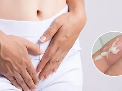 Bị ra huyết trắng nhiều có sao không và cách khắc phục
