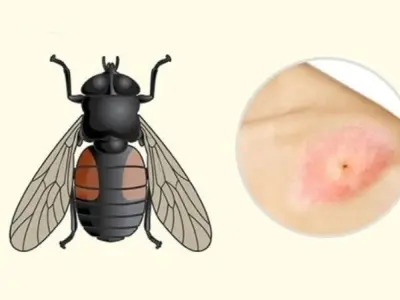 Bị ruồi cắn có sao không và cách xử lý nhanh chóng