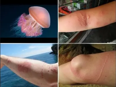 Bị sứa cắn có sao không và nên làm gì ngay lập tức