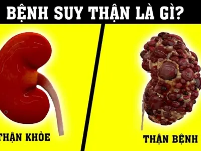Bị suy thận có sao không và cách nhận biết sớm nhất