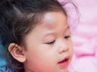 Bị u đầu có sao không dấu hiệu nguy hiểm cần lưu ý