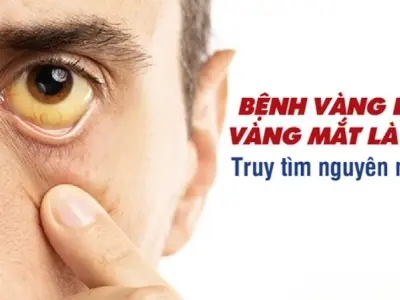 Bị vàng mắt có sao không? Nguyên nhân và cách xử lý