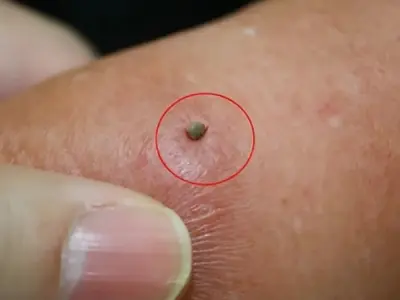 Bị ve cắn có sao không và cách xử lý an toàn