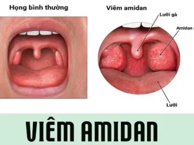 Bị viêm amidan có sao không và cách điều trị hiệu quả