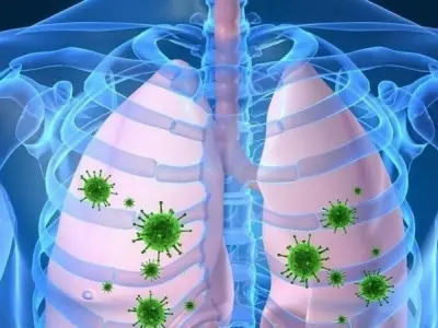 Bị viêm phổi có sao không? Dấu hiệu và cách xử lý