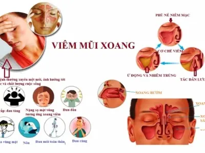 Bị viêm xoang có sao không và cách phòng ngừa hiệu quả