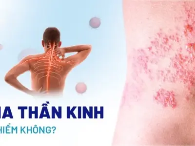 Bị zona có sao không và cách xử lý an toàn