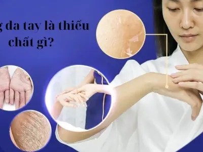 Bong da tay là thiếu chất gì và cách khắc phục hiệu quả