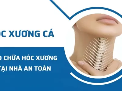 Tổng hợp cách chữa hóc xương cá bằng mẹo dân gian đơn giản