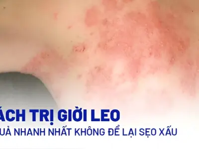 Chia sẻ cách chữa mẹo giời leo đơn giản dễ áp dụng tại nhà
