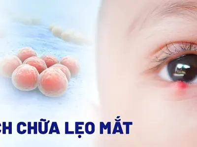 Cách chữa mẹo lên lẹo dân gian được truyền lại nhiều đời