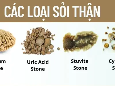 Sỏi thận hình thành như thế nào? Hiểu rõ nguyên nhân để phòng ngừa hiệu quả
