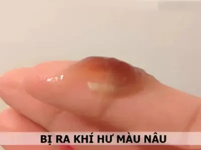 Giải đáp chi tiết: Dịch màu nâu có bị sao không