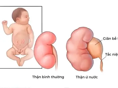 Em bé bị giãn thận có sao không và khi nào cần lo lắng