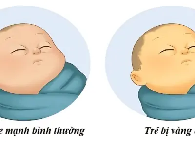 Em bé bị vàng da có sao không cách nhận biết sớm