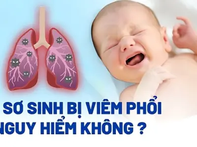 Em bé bị viêm phổi có sao không và cách xử lý kịp thời