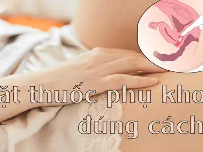 Hướng dẫn cách đặt thuốc phụ khoa tại nhà