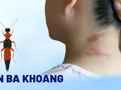 Kiến ba khoang cắn có bị sao không và cách xử lý kịp thời