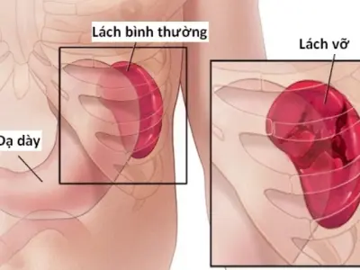 Lá lách to có bị sao không và cách nhận biết sớm