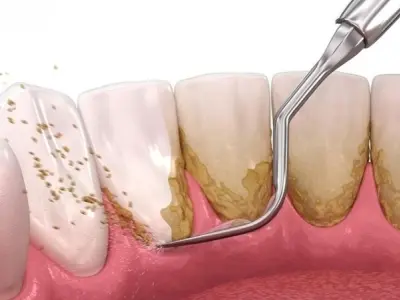 Tìm hiểu lấy cao răng có bị sao không và tác hại tiềm ẩn