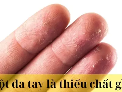 Lột da tay là thiếu chất gì? Cách nhận biết và xử lý