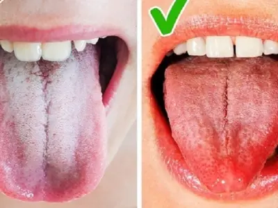 Lưỡi màu trắng có bị sao không và cách xử lý kịp thời
