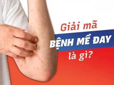 Cách chữa mề đay bằng mẹo siêu đơn giản ai cũng làm được