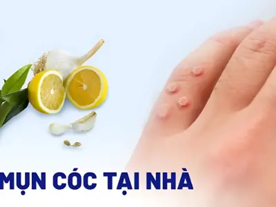 Bí quyết để chữa mẹo mụn cóc nhanh chóng không tái phát