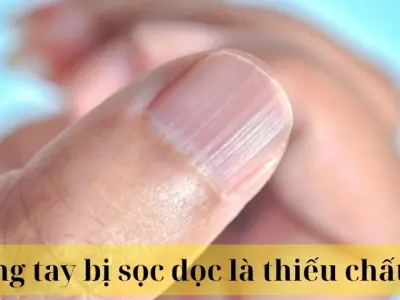 Móng tay bị sọc dọc là thiếu chất gì và nguy hiểm không?