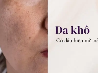 Như thế nào là da khô? Hiểu rõ để cấp ẩm và nuôi dưỡng làn da mịn màng