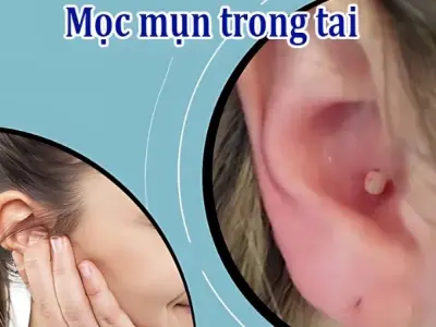 Mụn mọc trong tai có bị sao không và cách xử lý an toàn