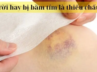 Người hay bị bầm tím là thiếu chất gì trong chế độ ăn