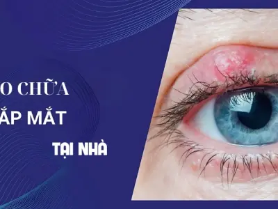 Cách chữa chắp mắt bằng mẹo dân gian đơn giản hiệu quả