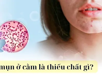Nổi mụn ở cằm là thiếu chất gì? Cảnh báo từ cơ thể