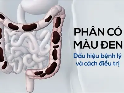Phân màu đen có bị sao không và cách xử lý tại nhà