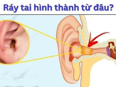 Ráy tai được hình thành như thế nào? Hướng dẫn chăm sóc tai đúng cách