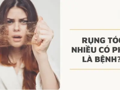 Rụng tóc nhiều có bị sao không? Cảnh báo từ chuyên gia