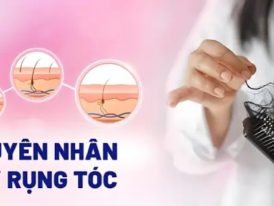 Tóc rụng nhiều có bị sao không và cách xử lý hiệu quả