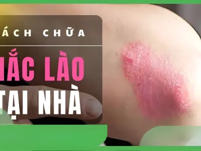 Bật mí cách chữa hắc lào bằng mẹo dân gian tại nhà