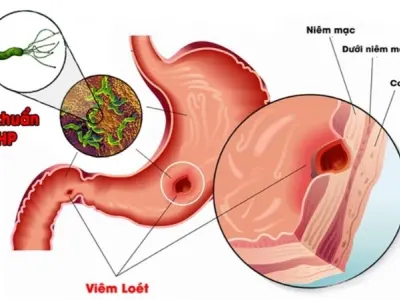 Viêm dạ dày HP có bị sao không và cách điều trị hiệu quả