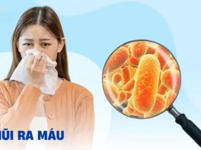 Xì mũi ra máu có bị sao không và khi nào nên đi khám