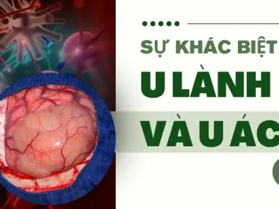 Phân biệt u và nang - Cách nhận biết u với nang chuẩn xác nhất