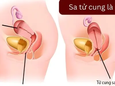 Cách tự kiểm tra sa tử cung bằng tay cho chị em bận rộn