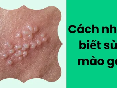 Cách nhận biết sùi mào gà với dấu hiệu sớm dễ bỏ qua